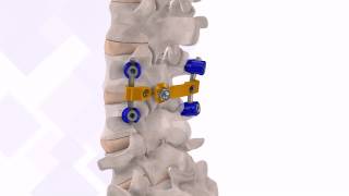 VTI InterLink™ Pedicle Screw Surgical Technique [upl. by Rtoip]