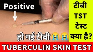 टीबी का Skin Test क्या है  Tuberculin Skin Test   TB Skin Test  TST से टीबी की जांच [upl. by Ikkin]