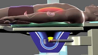 Shockwave Lithotripsy [upl. by Namqul]