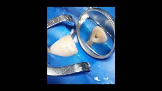 Maxillary Central Incisor Access Cavity Preparation [upl. by Eiluj]