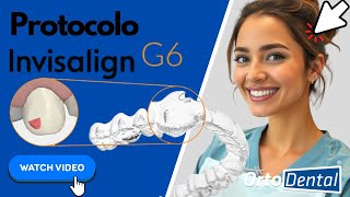 Invisalign G6 invisalignmexico alineadoresinvisibles extracciondental [upl. by Irbua]