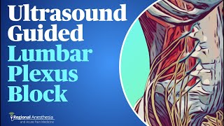 UltrasoundGuided Lumbar Plexus Block [upl. by Asp]