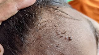 Remove all big lice from his hair  How to remove all hundred lice from his head [upl. by Gran]