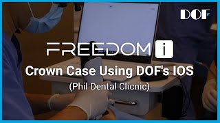 DOF  Crown Case Using DOFs IOS Phil Dental Clicnic [upl. by Amrita]