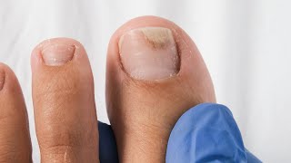 How to regrow a separated toenail Watch this ASAP [upl. by Pendleton526]