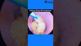 Kidney stone treatment  RIRS  Retrograde Intrarenal Surgery  URSL shortsviral [upl. by Cassie]