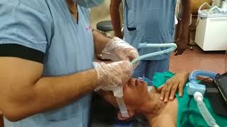 Video assisted Nasal Intubation [upl. by Nare991]