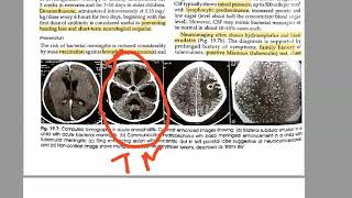 Pediatrics 569 Tuberculous meningitis Rich foci HYDROCEPHALUS Tuberculosis child [upl. by Justinian428]