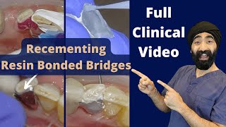 RBB Recementation Protocol  Adjusting Pontic Occlusion [upl. by Marys]