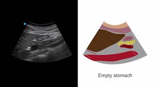 Assessing the stomach for NPO status [upl. by Nivrae562]