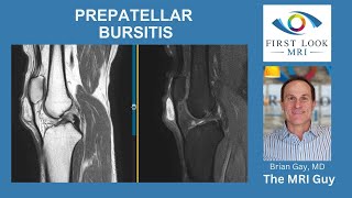 Prepatellar Bursitis [upl. by Lupita]