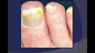 Toenail Debridement by a Podiatrist [upl. by Llednar]