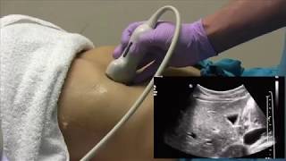 How I do it Ultrasound of the Abdomen [upl. by Hanimay870]