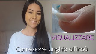 Visualizzare💅  Lezione 5 Correggere le unghie che crescono verso lalto  Ep 38 [upl. by Sedinoel]