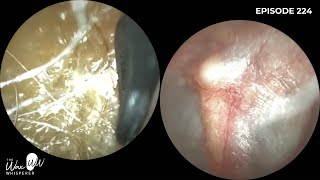 224  Ear Wax Removal using the Rai Angled Curette Ear Hook and Forceps using the WAXscope [upl. by Nimrac]