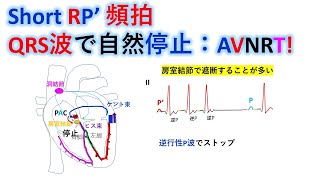 心電図：暗記からの卒業 129話 short RP 頻拍の自然停止 [upl. by Reggy]