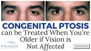 How Correcting Congenital Eyelid Ptosis can be Delayed as Long as Vision is Not Affected [upl. by Anna-Diana]