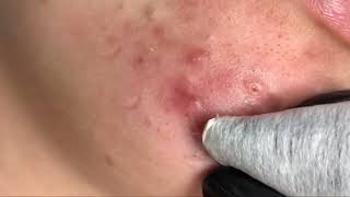 how to remove blackheads from nose and face  blackheads remover removeblackhead [upl. by Kahler]