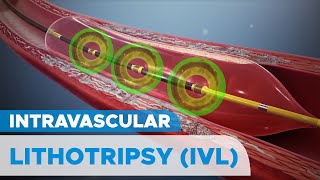 Shockwave Intravascular Lithotripsy IVL System for Severely Calcified Coronary Artery Plaques [upl. by Yde960]