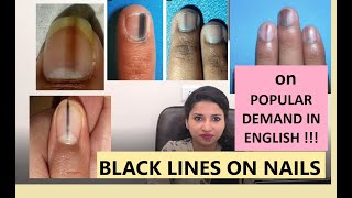 Black lines on nails what to do MBBS MD MAMC SKIN ENGLISH 2022 [upl. by Busiek]