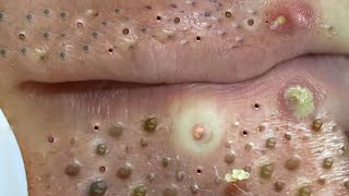 Big Cystic Acne Blackheads Extraction Blackheads amp Milia Whiteheads Removal Pimple Popping  703 [upl. by Indnahc134]