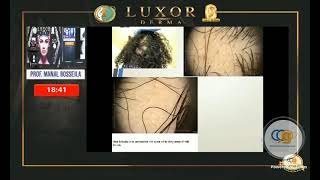 Basic Trichoscopy by Dr Manal Bosseila [upl. by Nonna885]