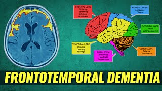 Bruce Willis has frontotemporal dementia – symptoms  causes amp treatment [upl. by Erastus764]