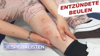 Beulen an den Beinen Parasitenbefall  Auf Streife  Die Spezialisten  SAT1 TV [upl. by Tedmann643]