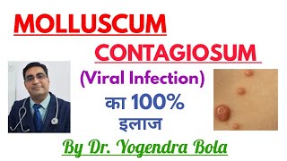 Molluscum Contagiosum ka 100 Treatment [upl. by Turk]