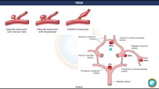 HEMORRAGIA SUBARACNOIDEA Y HEMATOMA SUBDURAL  ACTIVIDAD ACADÉMICA [upl. by Haodnanehs]