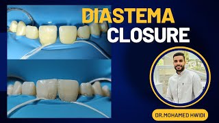 Diastema closure with composite [upl. by Salvadore]