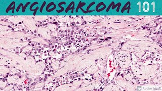 Angiosarcoma 101 for Pathologists and Dermatologists [upl. by Anilram]