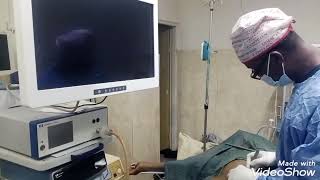 Laparoscopic Appendectomy for A Young man with Acute Appendicitis at Queens heritage hospital kano [upl. by Muncey]