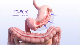 ESG Animation Endoscopic Sleeve Gastroplasty [upl. by Eenyaj44]