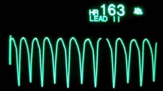 Ventricular Tachycardia [upl. by Bihas910]