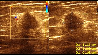 Breast Carcinoma  Fibroadenoma Breast  Benign Vs Malignant Breast Masses [upl. by Dierdre]