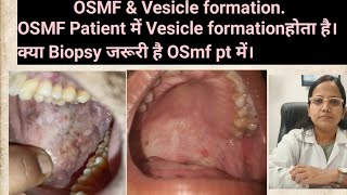 OSMF amp Vesicle formationOSMF Patient में Vesicle formation होता है तो क्या Biopsy जरूरी हैOSmf pt [upl. by Ecenaj362]