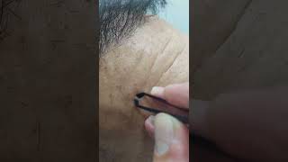 Alnındaki taş gibi olan sivilce blackheads Extractions blackheads extractions [upl. by Sinnej]