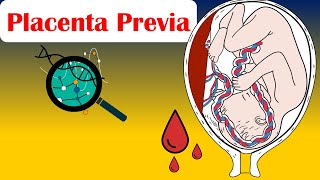 Placenta Previa  Causes Risk Factors Signs amp Symptoms Diagnosis And Treatment [upl. by Cynthea697]