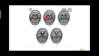 Grades of Tonsillar Enlargement [upl. by Eillat426]