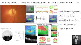 Lecture Using OCT as an Approach to Diagnose Glaucomatous and Other Optic Neuropathies [upl. by Legnaesoj]