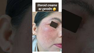 Steroid creams का दुरूपयोग 😥 Medisalic Betnovate MemopiHC No scars का उपयोग खुद से कभी ना करें [upl. by Ulrika]