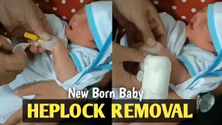 Heplock removal  New born baby [upl. by Mashe]