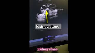 Right Renal calculus…video viralshorts kidney stone doctor views tiktok radiologist [upl. by Rap]