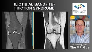 ILIOTIBIAL BAND ITB FRICTION SYNDROME [upl. by Yona]