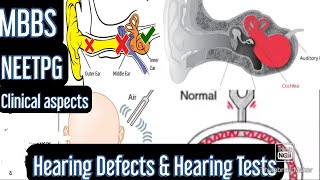 Hearing Defects amp Hearing Tests Rinnes test Webers test Schwabachs test mbbs neetpg [upl. by Eiramnna611]