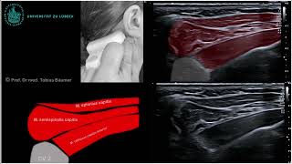 Sonographische Darstellung der kurzen Nackenmuskeln [upl. by Mozelle]