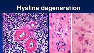 Hyaline Change 💚 [upl. by Kassie]