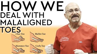 How We Deal with Malaligned Toes aka Hammer Toes [upl. by Swayne]