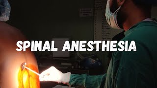 How to give spinal anesthesia  LEARN IN 1 MINUTE [upl. by Avirt]